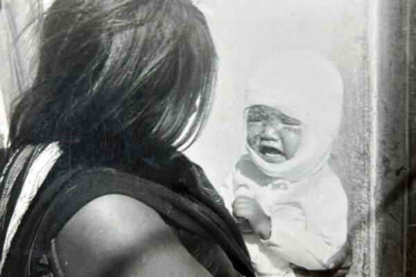 Bandaged baby during the Vietnam war
