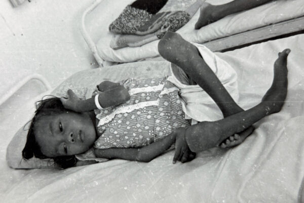 Sick and emaciated child in hospital war during the Vietnam war